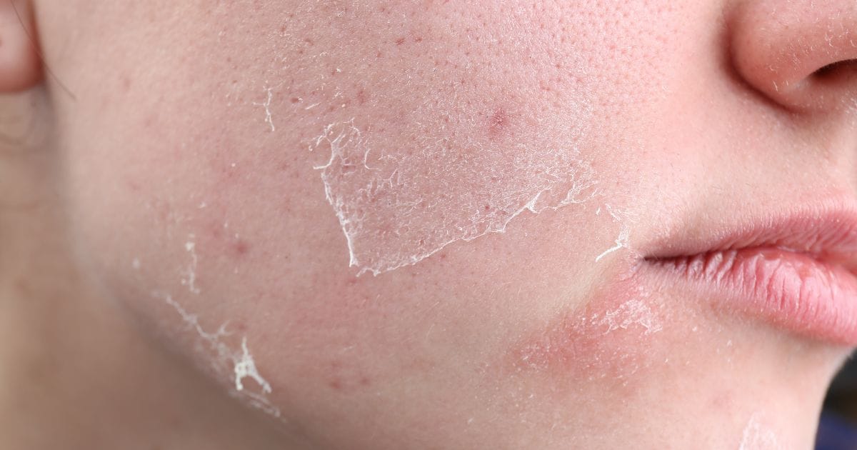 woman cheek with peeling skin