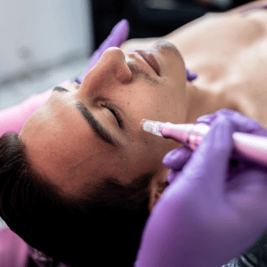 man laying on the table getting micorneedling