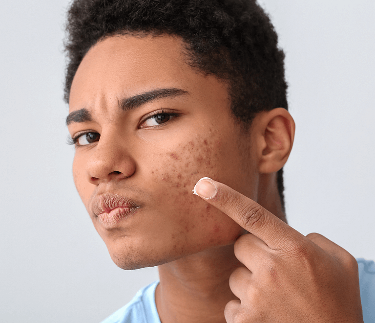 Teen looking at his acne in the mirrow