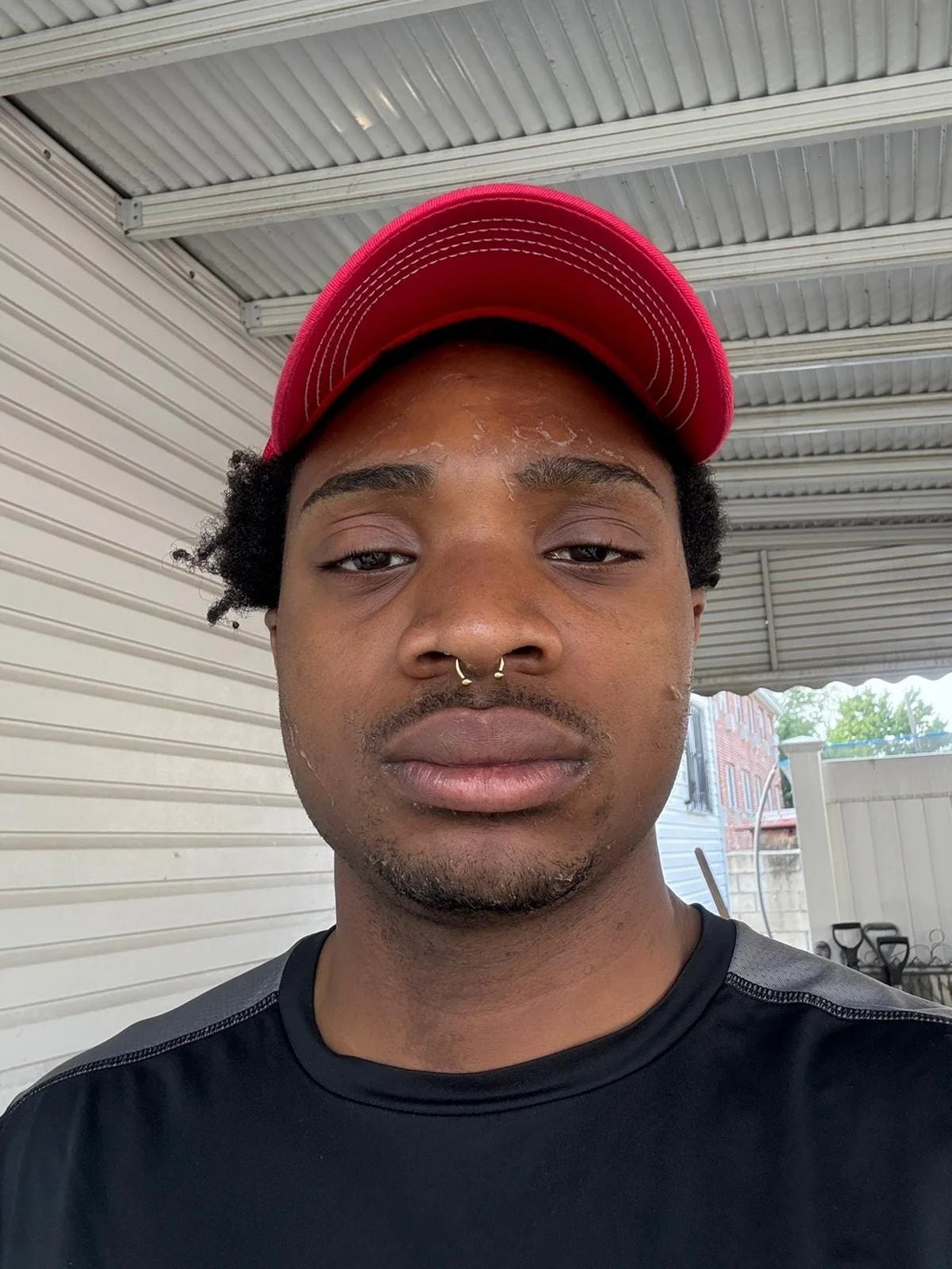 Man's face after VI Peel